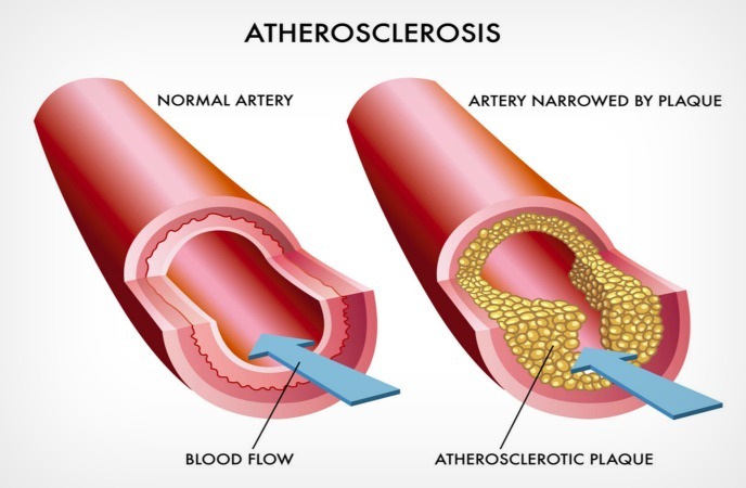 Image showing clogged artery caused by atherosclerosis