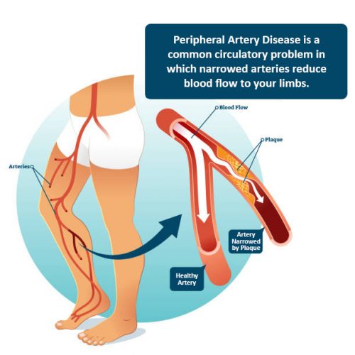 PAD - Peripheral Artery Disease diagnosis and treatment in Mission, TX