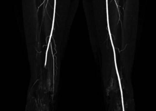 Lower Extremity angiogram in Texas - Mission Vascular Center of Excellence