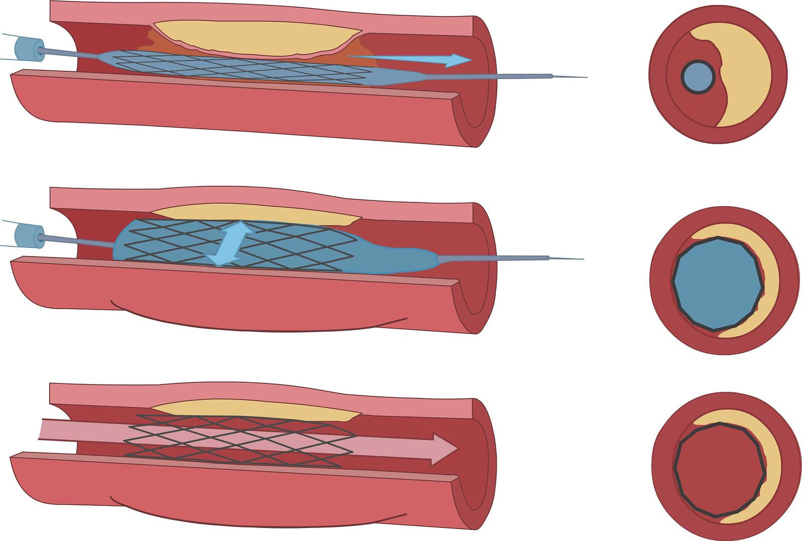 Endovascular Angioplasty and Stent Example Image - Mission Vascular 